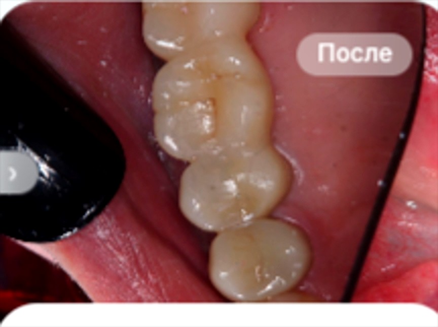 После лечения — Протезирование зубов