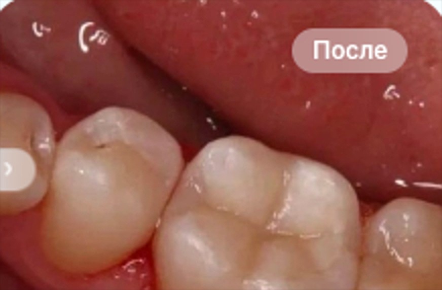 После: Лечение кариеса и замена пломбы